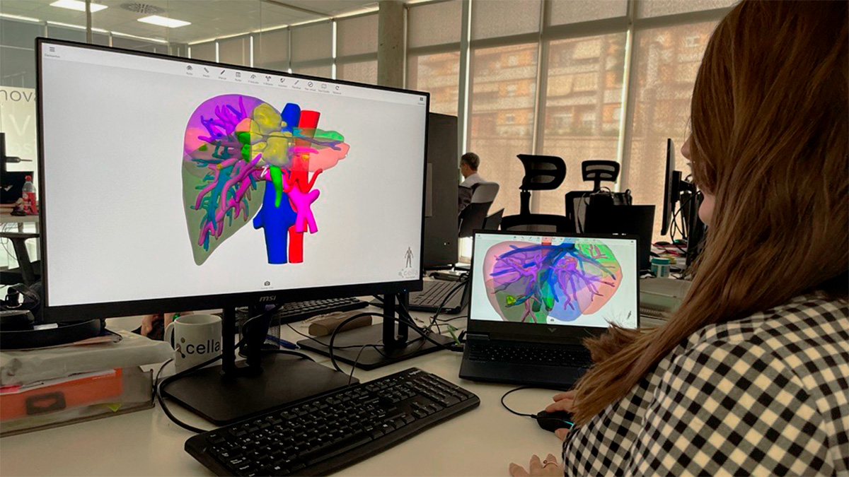 Una 'startup' ayuda a los cirujanos con sus modelos en 3D de órganos de pacientes