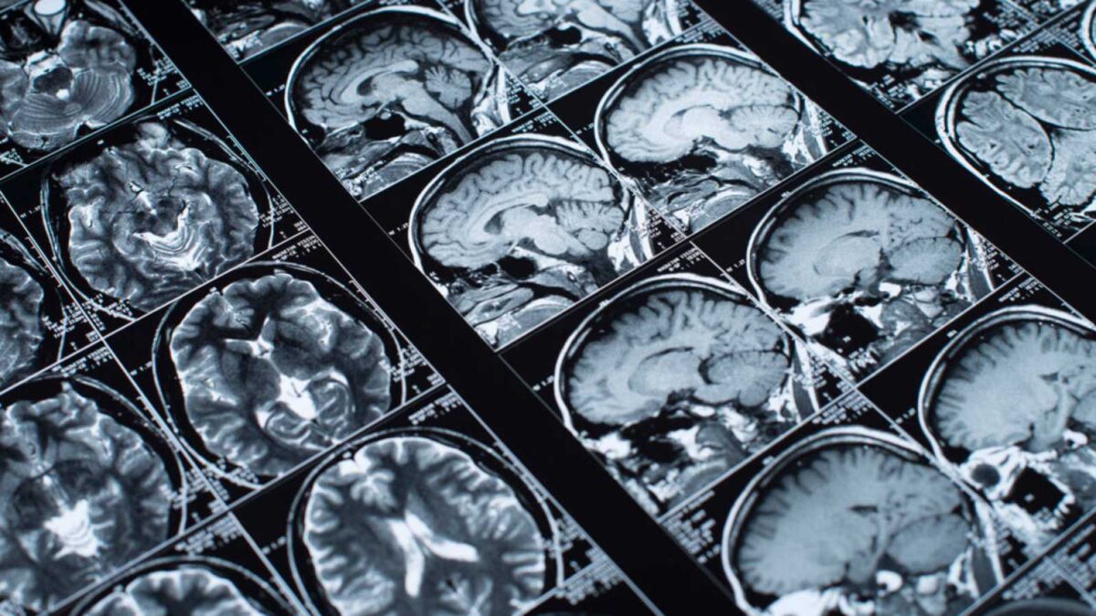 Identificado un nuevo biomarcador en el tumor cerebral de peor pronóstico en adultos
