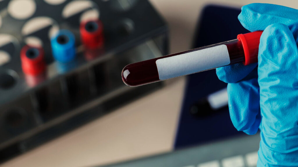 Un médico sostiene un tubo de ensayo con sangre