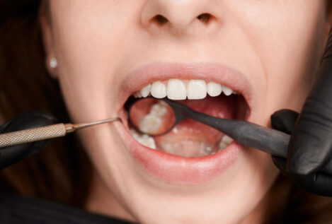 Caries en los dientes: estas son las piezas que más sufren (y cómo evitarlo)