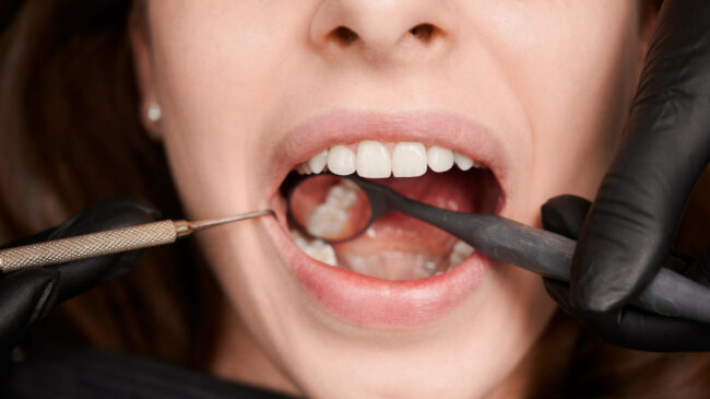 Caries en los dientes: estas son las piezas que más sufren (y cómo evitarlo)