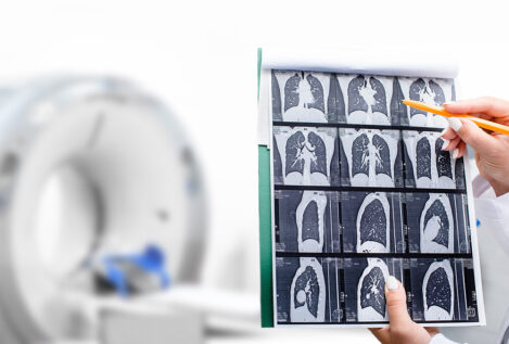 La importancia de la detección precoz del cáncer de pulmón