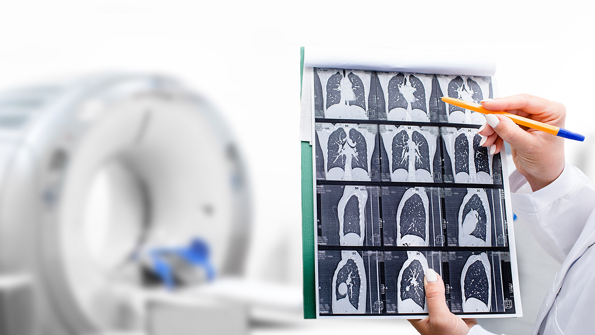 La importancia de la detección precoz del cáncer de pulmón