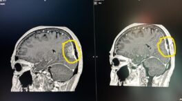 Un revolucionario sistema de radiocirugía cura a una mujer con metástasis cerebral avanzada