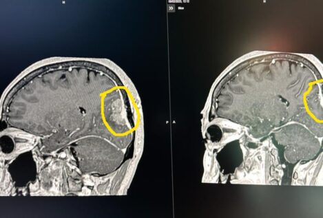 Un revolucionario sistema de radiocirugía cura a una mujer con metástasis cerebral avanzada