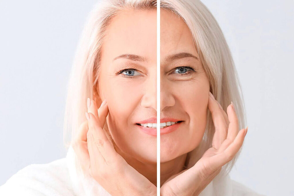 Antes y después de un tratamiento Total Full Face. (Fuente: Simetrya Clinic)