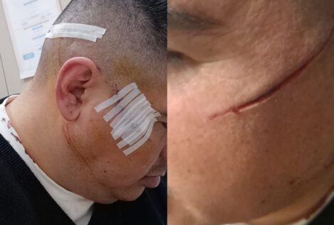 Brutal agresión en Badalona: acuchillan la cara de un vecino tras intentar robarle
