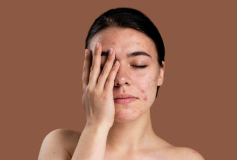 Los efectos secundarios del Roacután, el fármaco más común para tratar el acné