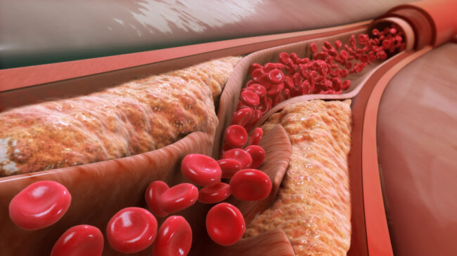 Una proteína más útil que el colesterol para predecir el riesgo de infarto
