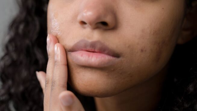 Los alimentos que debes evitar para cuidar tu piel y eliminar el acné