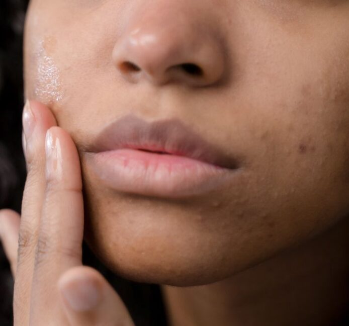 Los alimentos que debes evitar para cuidar tu piel y eliminar el acné