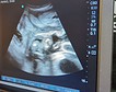 La nueva baja de incapacidad por embarazo dejará fuera a un tercio de las mujeres