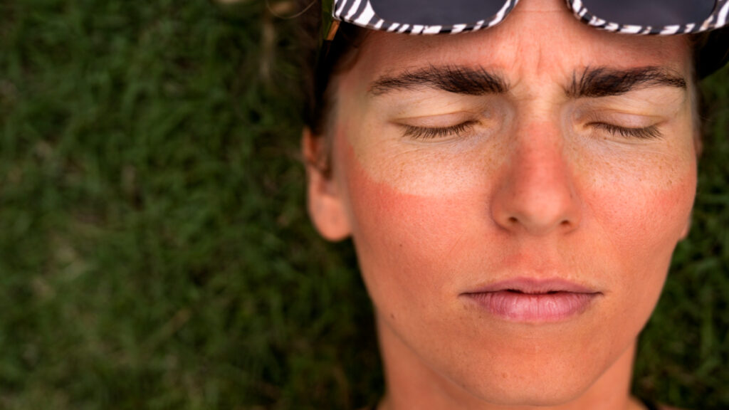 Una mujer con una quemadura solar en la cara