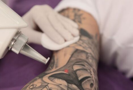 La eliminación de tatuajes en España crece un 30% entre los tratamientos de láser estético