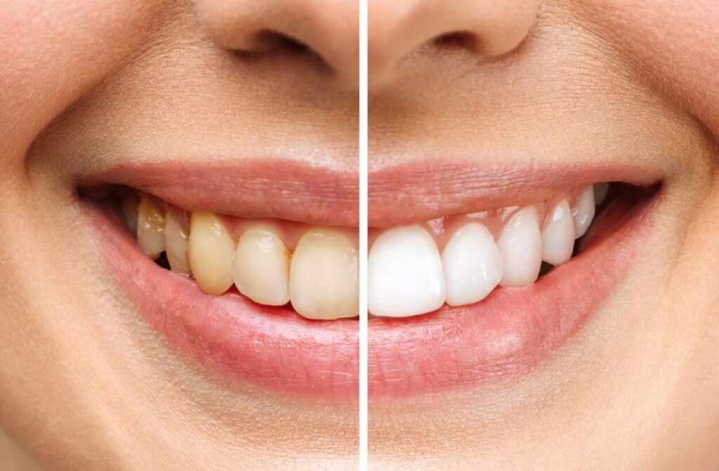 Diferencia entre unos dientes con manchas y una sonrisa ideal. (Fuente: Bastida Clínica Dental)