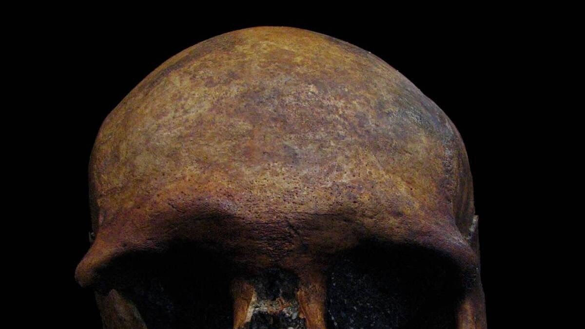 Detectado un caso de tumor craneal de época romana en la península ibérica