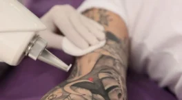 El auge de la eliminación de tatuajes: así es el proceso, su duración y coste