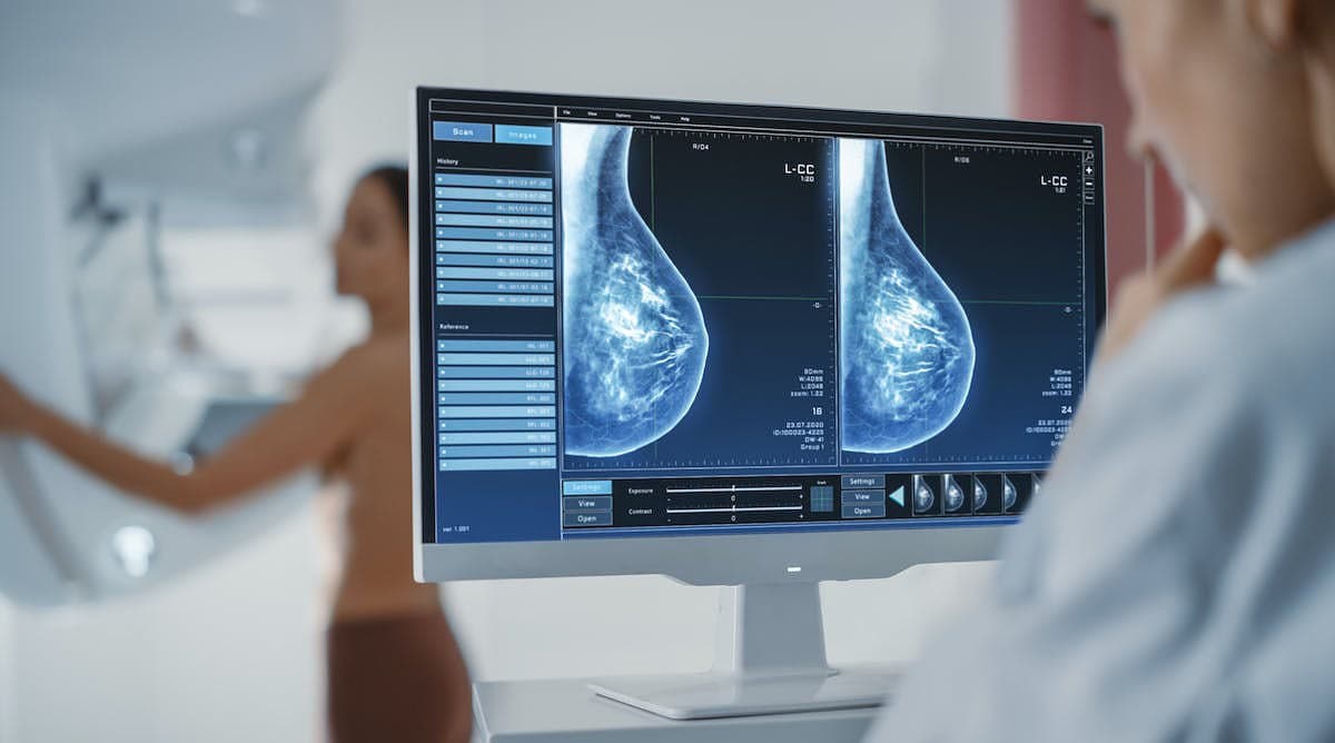 Mamografías periódicas y ejercicio físico, claves en el pronóstico del cáncer