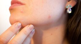 Este es el motivo por el que sale acné con la regla y así se puede prevenir