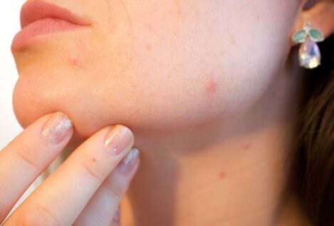Este es el motivo por el que sale acné con la regla y así se puede prevenir