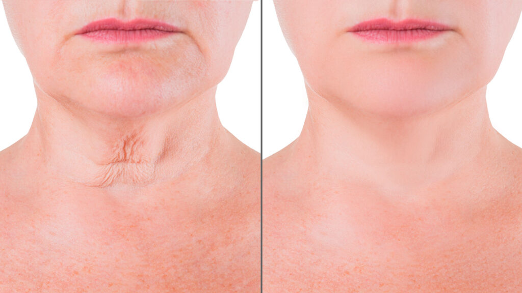 Antes y después de un lifting cervical. (Fuente: Dr. Pedro Vidal)
