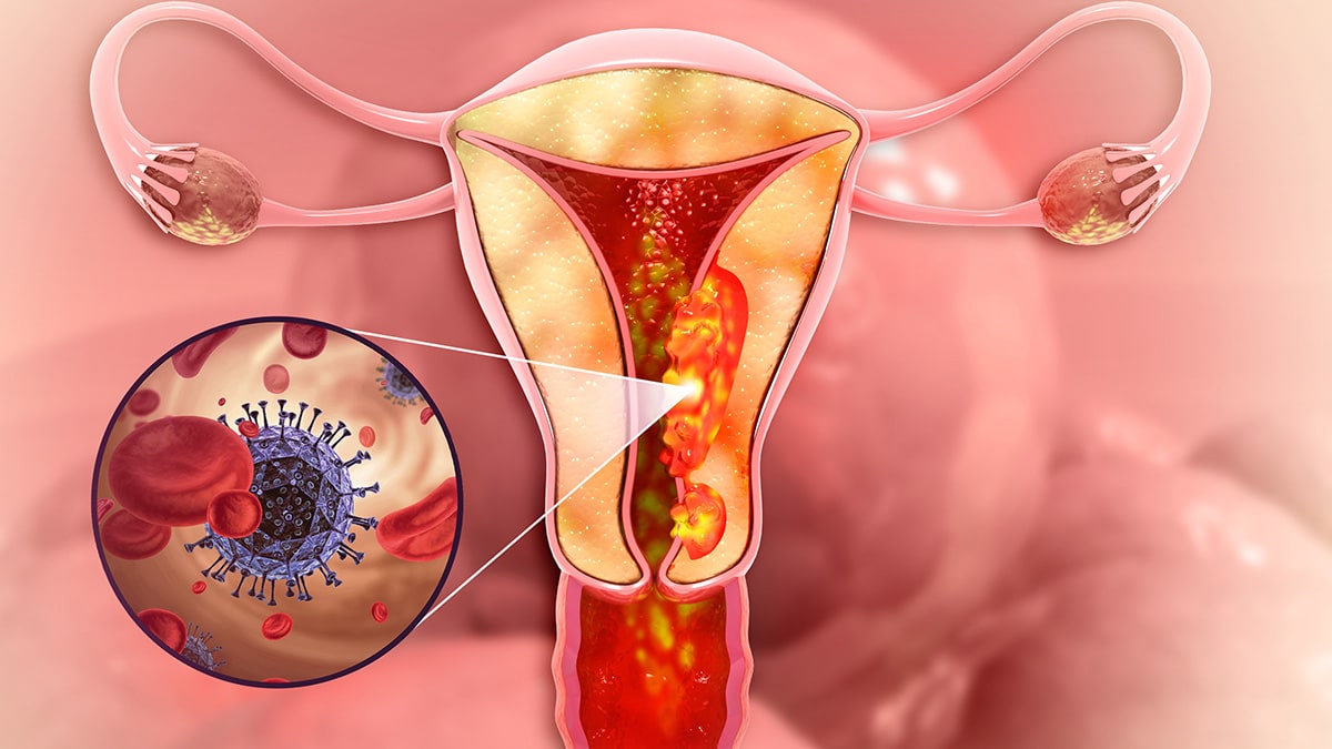 El cáncer de cérvix o de cuello de útero, el más frecuente en el aparato reproductor femenino