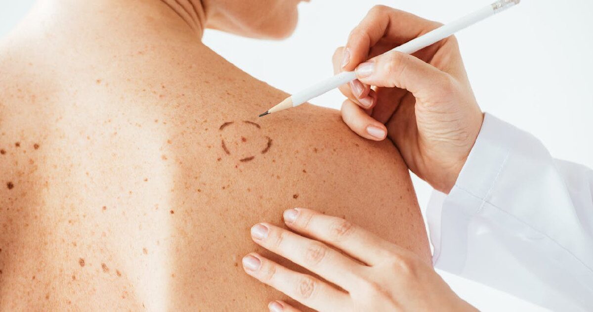 Llegan las vacunas contra el melanoma: ¿cómo funcionan?