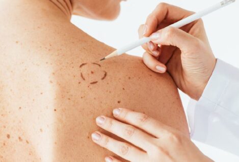 Llegan las vacunas contra el melanoma: ¿cómo funcionan?