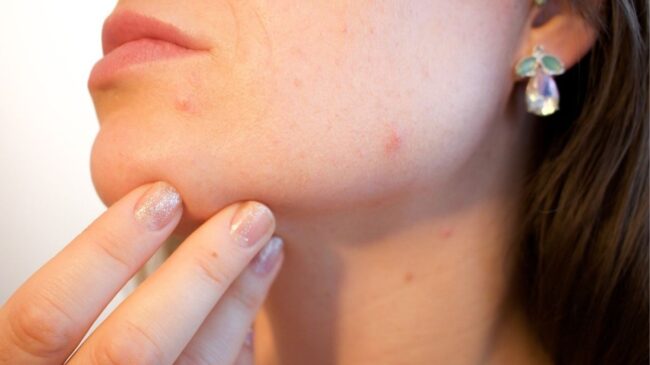 Elimina definitivamente el acné con estos cuatro métodos
