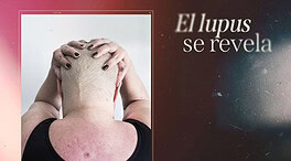AstraZeneca y Felupus lanzan una campaña para visibilizar el lupus a través de la fotografía