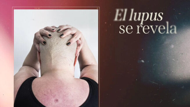 AstraZeneca y Felupus lanzan una campaña para visibilizar el lupus a través de la fotografía