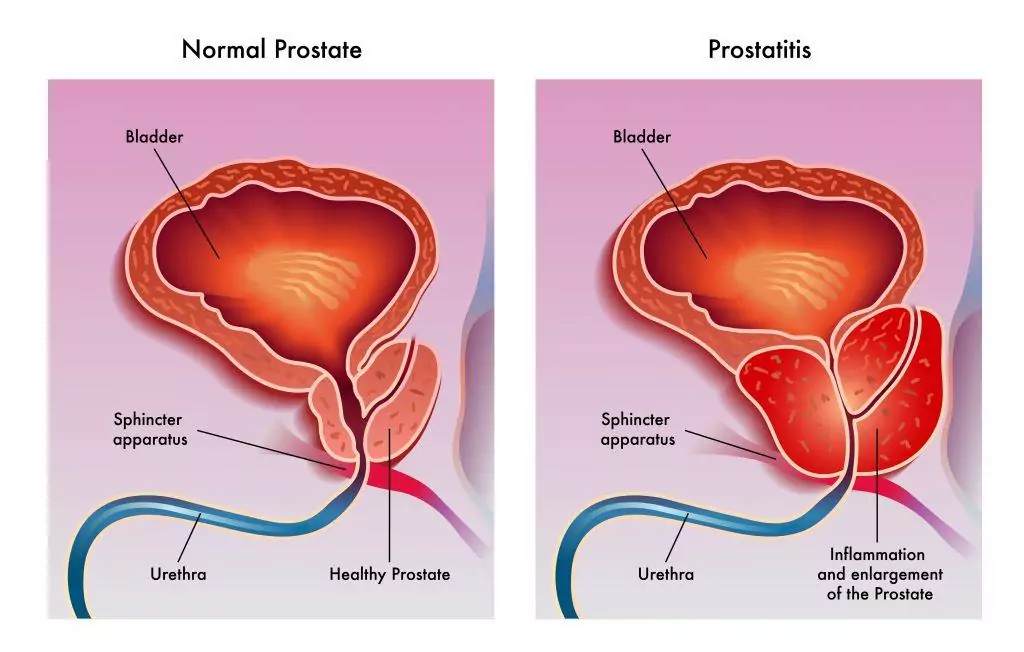 Diferencia entre una próstata sana y una próstata inflamada. 
ROC Clinic