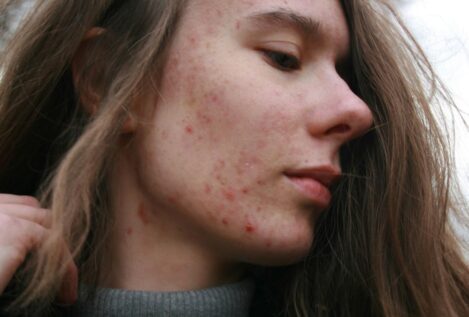 ¿Cómo puede cambiar la piel con un brote de acné?