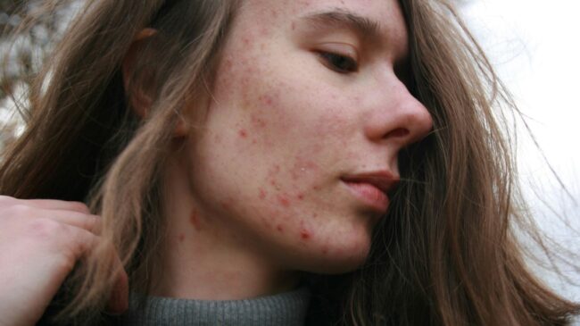 ¿Cómo puede cambiar la piel con un brote de acné?