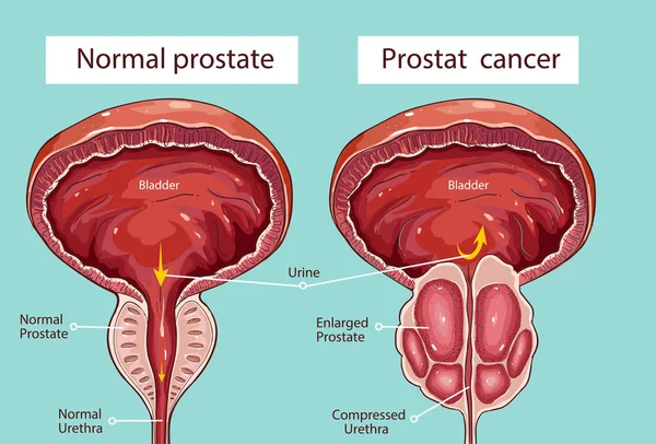 Próstata inflamada. 
Depositphotos