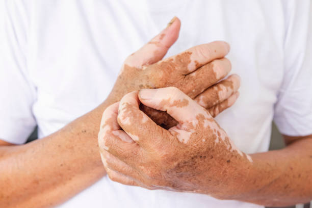 Manos  afectadas por el vitiligo. iStock