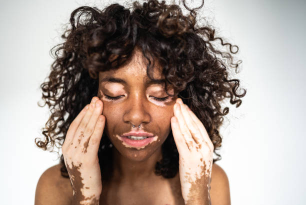 Modelo con vitiligo. 
iStock