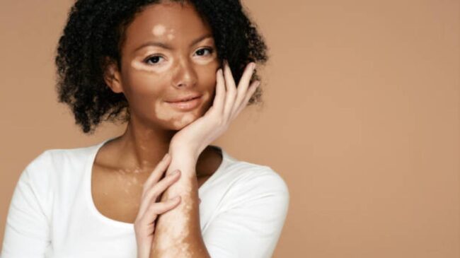 Día Mundial del Vitiligo: qué es, cómo se cura y personas propensas a tenerlo