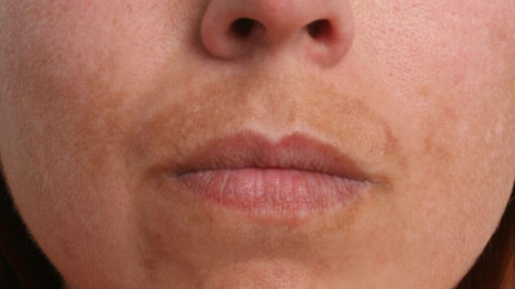 Melasma quitar manchas