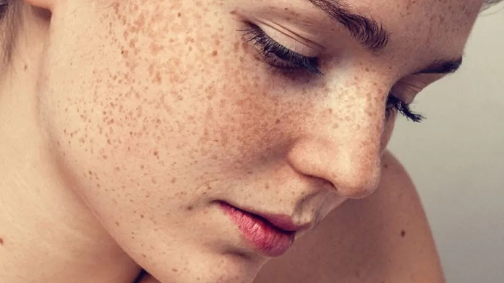 Mujer con manchas faciales. (Fuente: Sesderma)