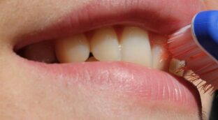 La eficacia de la fluoración del agua en la prevención de caries es cada vez menor