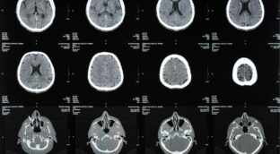 El motivo por el que aumenta el deterioro cognitivo y el Alzheimer, según un estudio