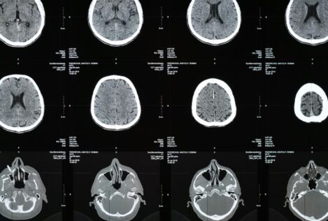 El motivo por el que aumenta el deterioro cognitivo y el Alzheimer, según un estudio