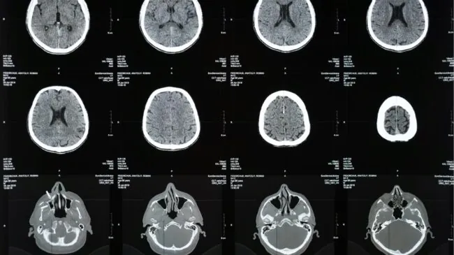 El motivo por el que aumenta el deterioro cognitivo y el Alzheimer, según un estudio