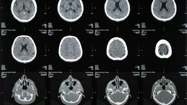 El motivo por el que aumenta el deterioro cognitivo y el Alzheimer, según un estudio