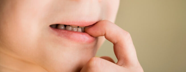 Qué es la hipomineralización molar, los 'dientes de tiza' que aparecen en el 25% de los menores