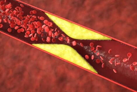 Las seis señales para saber si tengo el colesterol alto sin hacerme una analítica
