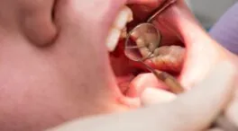 ¿Cómo saber si tengo caries o manchas en los dientes?