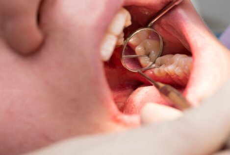 ¿Cómo saber si tengo caries o manchas en los dientes?