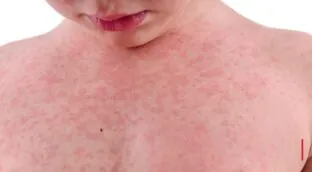 Cuando el metal hiere: guía para la prevención de la dermatitis de contacto